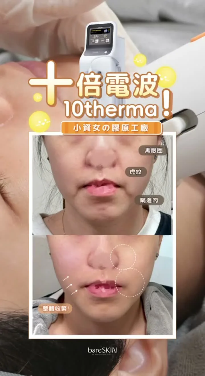 10THERMA客人療程前後影片封面